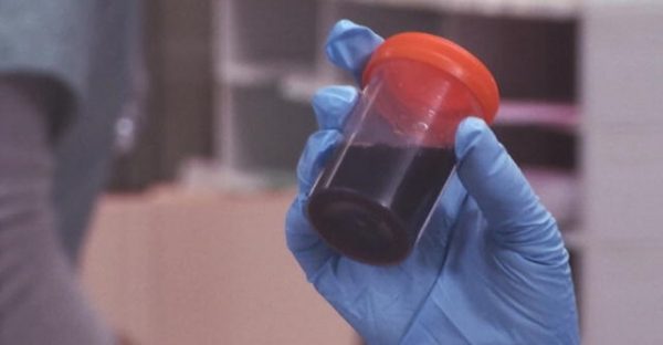 Nove casos suspeitos da ‘doença da urina preta’ são registrados no Ceará
