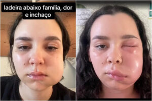 Jovem é internada com infecção após cirurgia para retirar os sisos