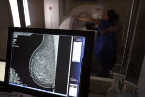 Entidades médicas defendem mamografia de rastreio a partir dos 40 anos
