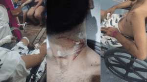 Entregador sofre ferimentos graves após ter pescoço enroscado em fios soltos na rua em Quixadá