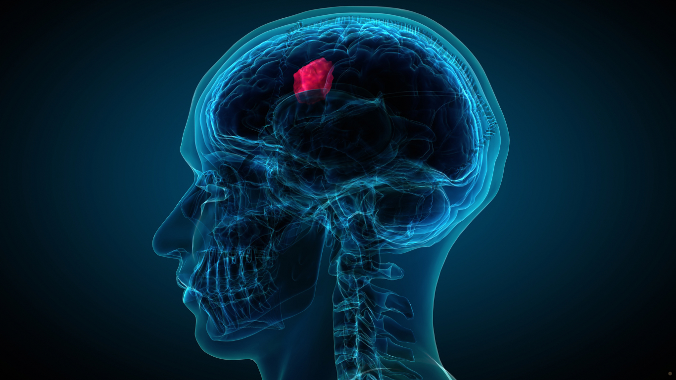 Anvisa aprova primeiro tratamento oral para gliomas de baixo grau no Brasil